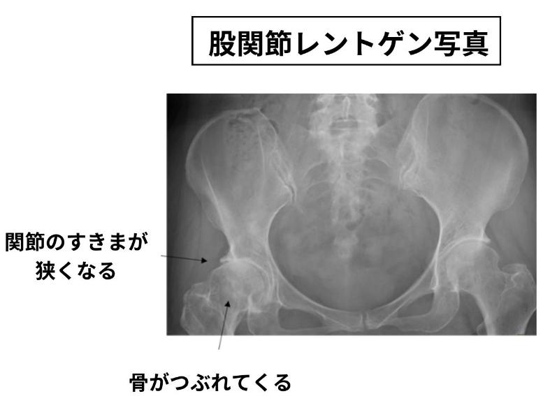 股関節学 整形外科 - 健康/医学